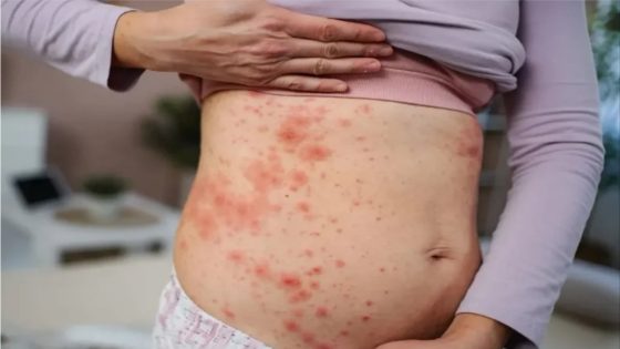 داء الحصبة يتفشى بالولايات المتحدة